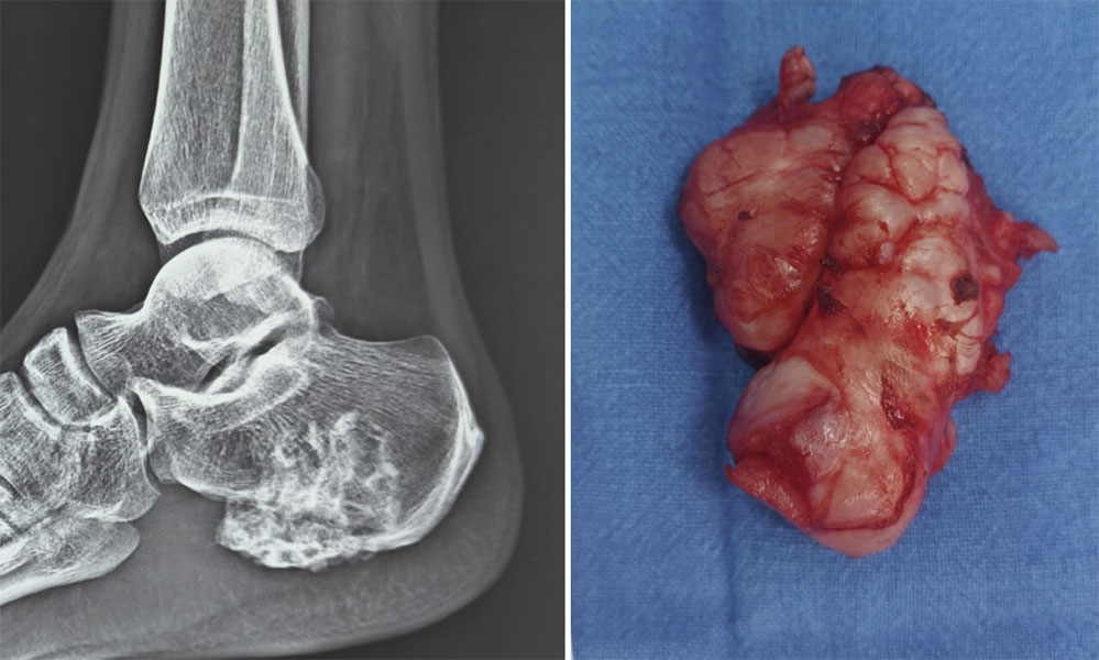 Surgical removal of an osteochondroma Surgical removal of an osteochondroma