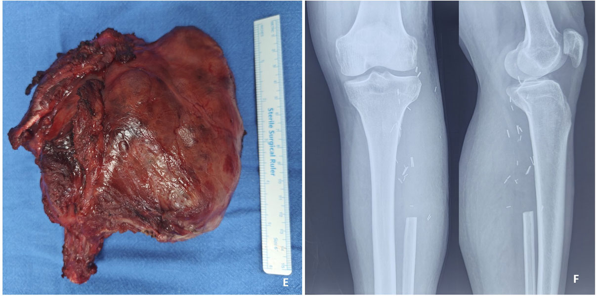 Surgical resection of a giant cell tumor of the upper fibula
