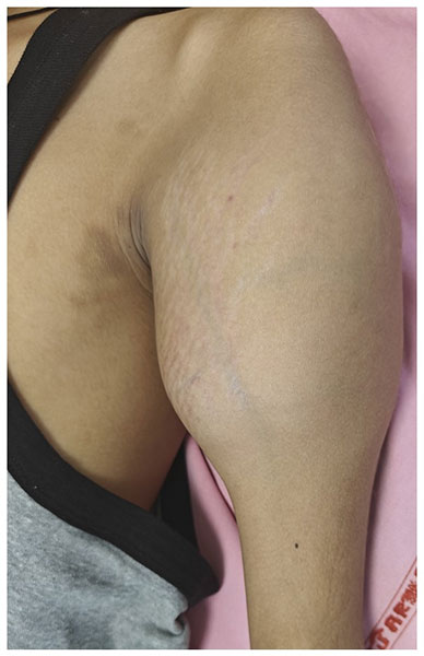 Swelling around the shoulder may be a sign of an underlying bone tumor Swelling around the shoulder may be a sign of an underlying bone tumor