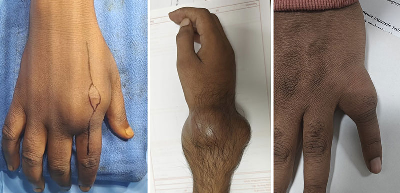 Swelling caused by a bone tumor of the hand and wrist Swelling caused by a bone tumor of the hand and wrist