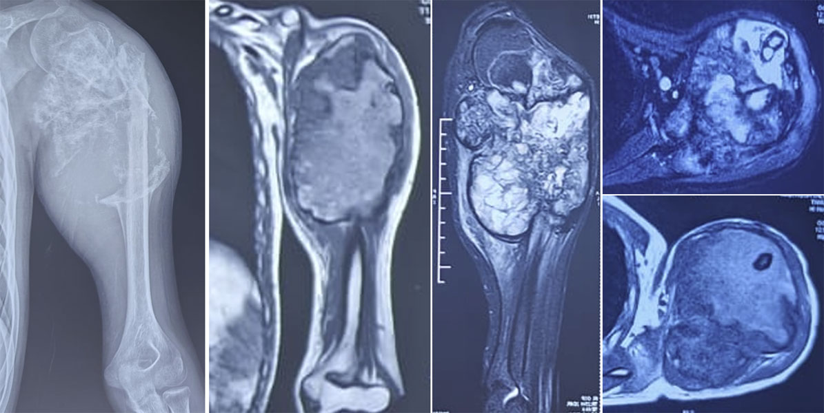 Telangiectatic osteosarcoma of the upper arm Telangiectatic osteosarcoma of the upper arm