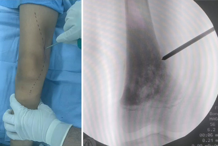 The biopsy needle is advanced along the planned tract toward the bone tumor
