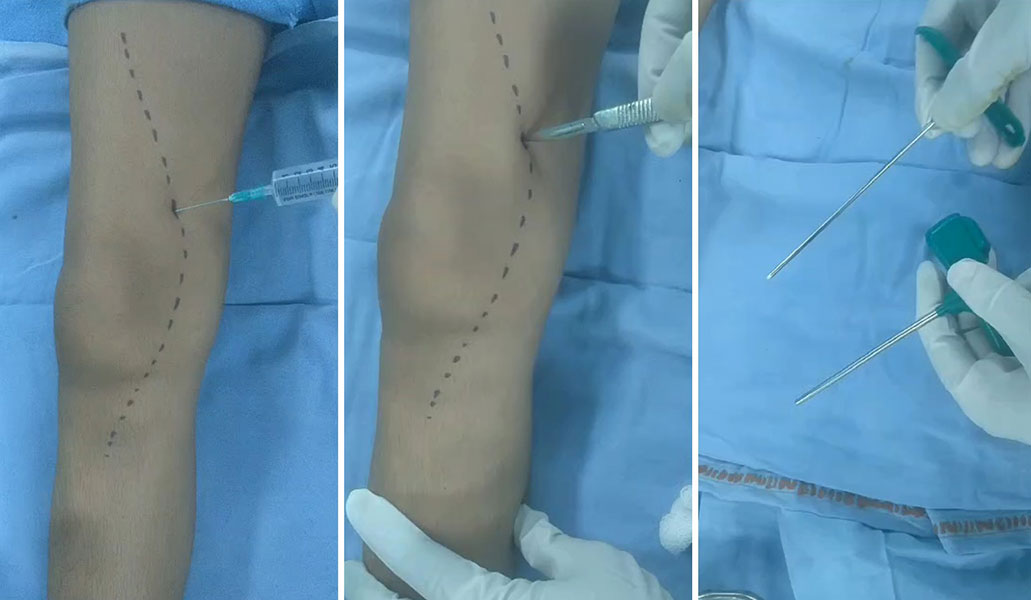 The biopsy site and tract are carefully planned and marked before needle insertion