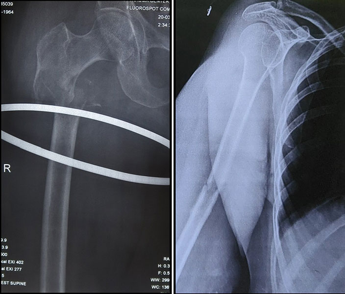 The thigh bone and upper arm bone are common sites for pathological fractures The thigh bone and upper arm bone are common sites for pathological fractures