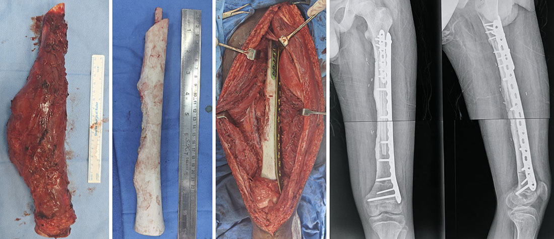 The tumor-bearing bone was widely removed, sterilized with high-dose radiation, and reimplanted for biological reconstruction, with good bone incorporation The tumor-bearing bone was widely removed, sterilized with high-dose radiation, and reimplanted for biological reconstruction, with good bone incorporation