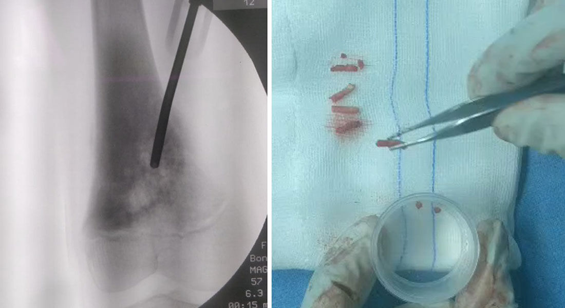 Tissue cores are obtained through the biopsy needle for pathological examination