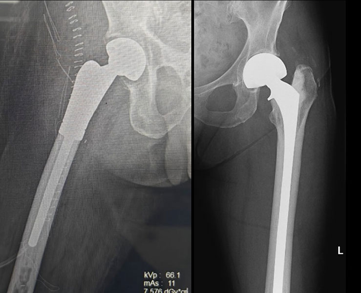 Tumor prosthesis reconstruction can help patients bear weight early and regain function Tumor prosthesis reconstruction can help patients bear weight early and regain function