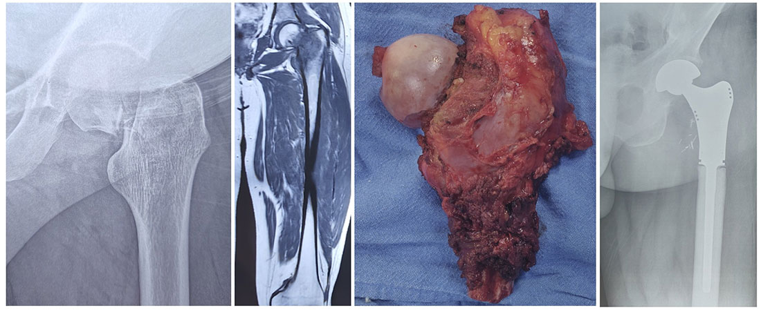 Tumor removal followed by reconstruction with a tumor prosthesis for early mobilization Tumor removal followed by reconstruction with a tumor prosthesis for early mobilization
