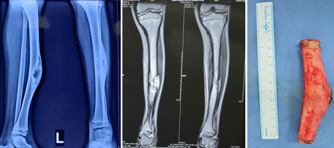 Tumor resection with vascularized fibula reconstruction