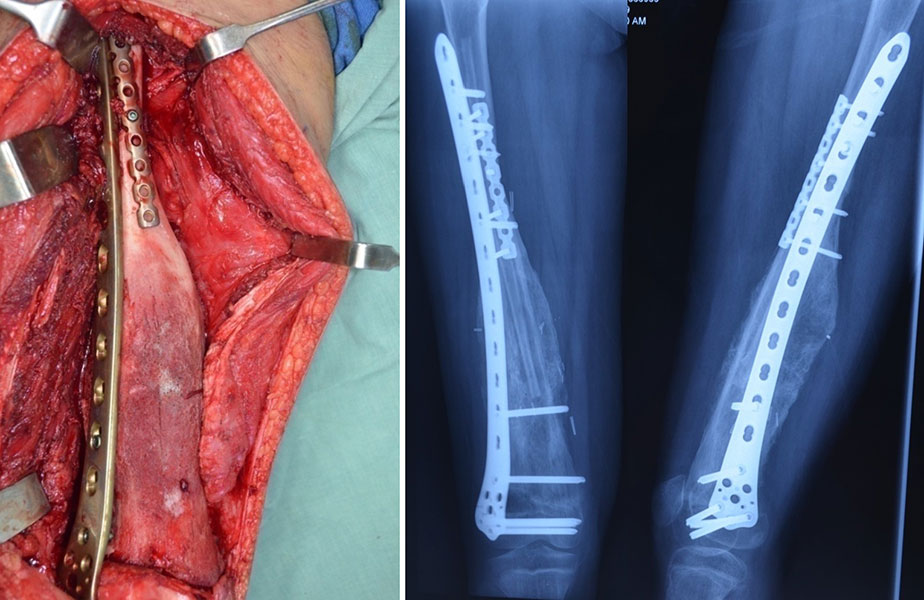 Wide resection and biological reconstruction for osteosarcoma