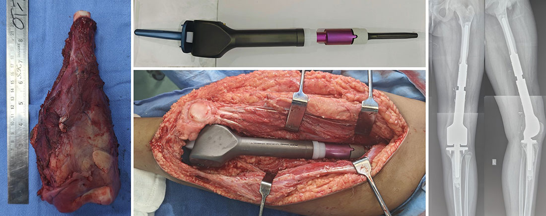 Wide resection and expandable prosthetic reconstruction Wide resection and expandable prosthetic reconstruction