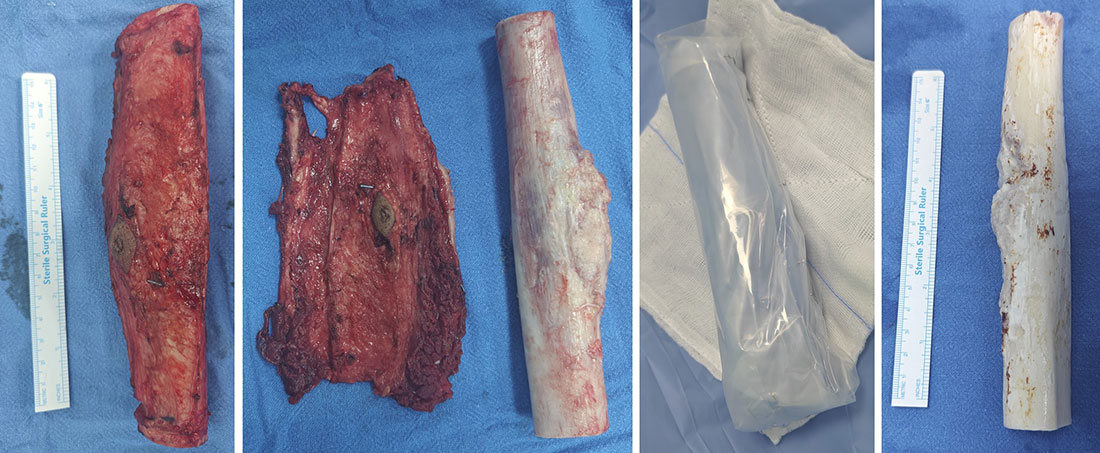 Wide resection of the tibial tumor with clearance of the surrounding soft tissues, followed by sterilization of the removed bone with high-dose radiation Wide resection of the tibial tumor with clearance of the surrounding soft tissues, followed by sterilization of the removed bone with high-dose radiation