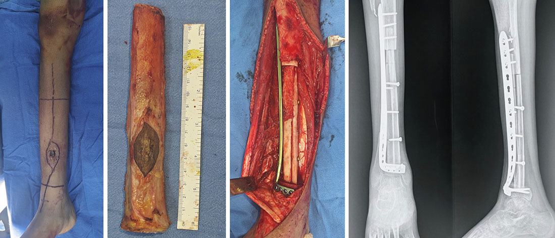 Wide resection of the tibial tumor followed by biological reconstruction using a vascularized fibular graft and internal fixation Wide resection of the tibial tumor followed by biological reconstruction using a vascularized fibular graft and internal fixation