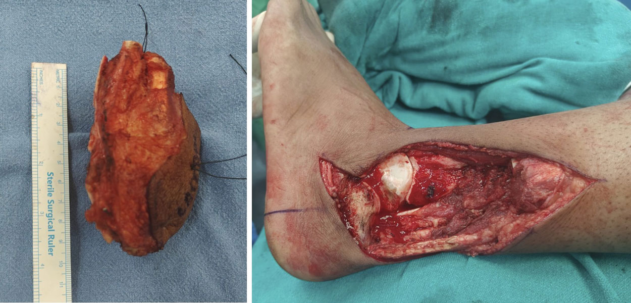 Wide surgical resection of a soft tissue sarcoma around the ankle Wide surgical resection of a soft tissue sarcoma around the ankle