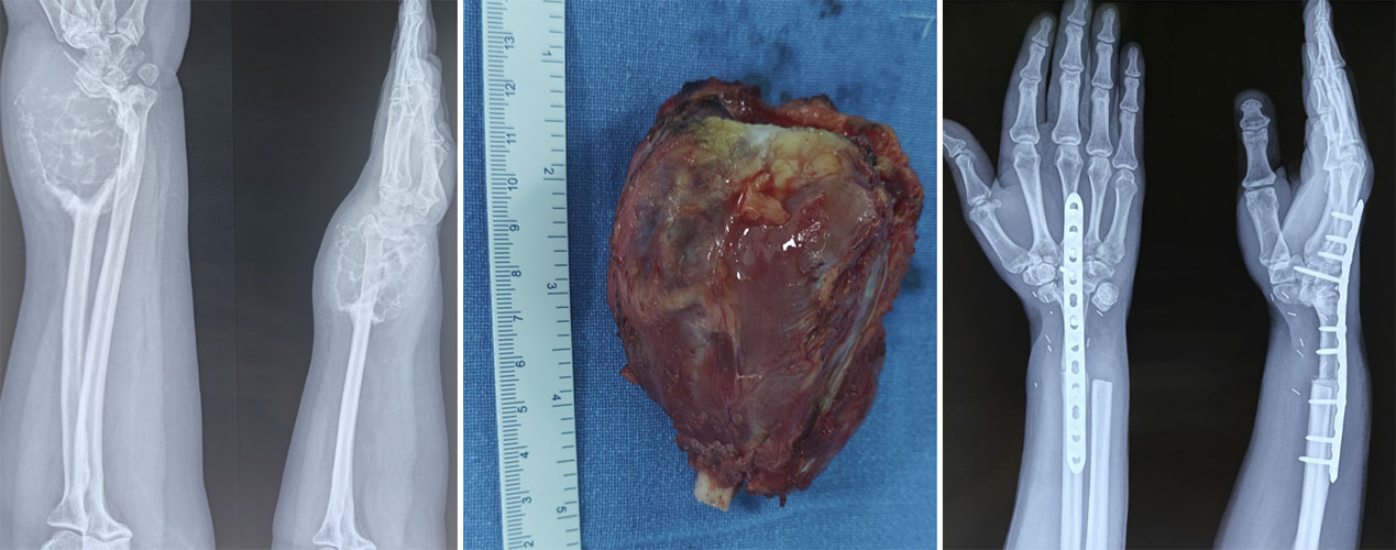 Wide surgical resection of an extensive giant cell tumor of bone, removing the tumor along with the involved bone Wide surgical resection of an extensive giant cell tumor of bone, removing the tumor along with the involved bone