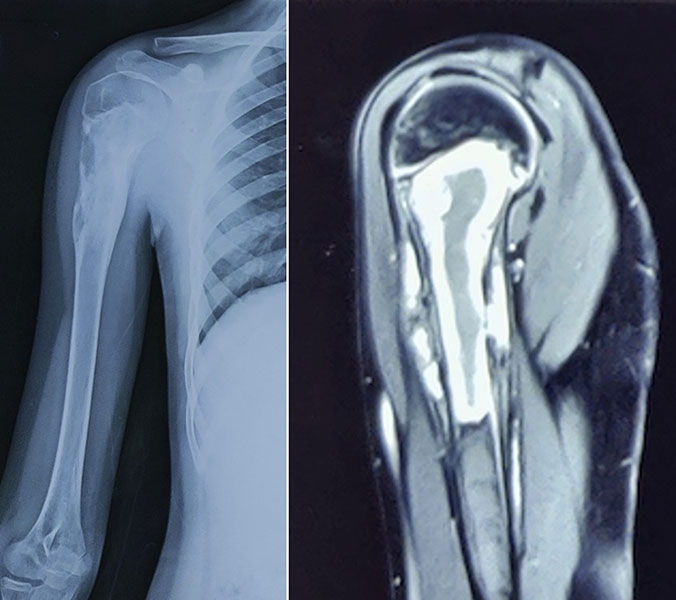 X-ray and MRI showing Ewing sarcoma of the proximal humerus and the extent of the tumor X-ray and MRI showing Ewing sarcoma of the proximal humerus and the extent of the tumor