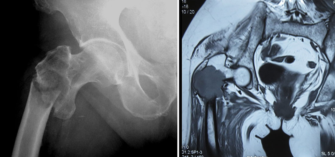 X-ray and MRI showing a fracture through an underlying bone lesion X-ray and MRI showing a fracture through an underlying bone lesion