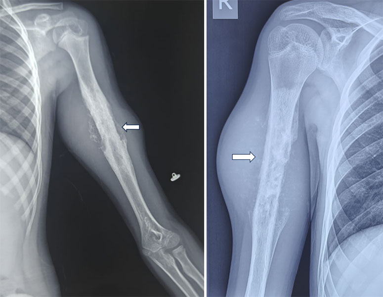 X-ray and MRI showing a malignant bone tumor of the humerus, demonstrating the importance of detailed imaging before arm bone tumor surgery