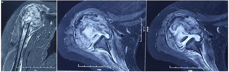 X-ray and MRI showing osteosarcoma of the proximal humerus X-ray and MRI showing osteosarcoma of the proximal humerus