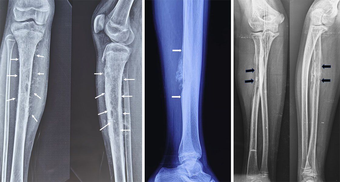 X-ray appearance of Ewing sarcoma in the forearm X-ray appearance of Ewing sarcoma in the forearm