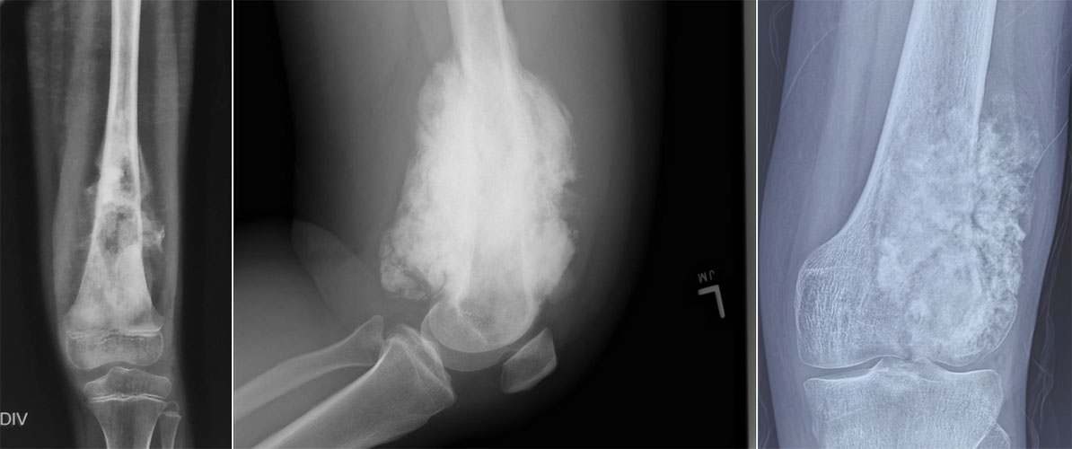 X-ray appearance of osteosarcoma X-ray appearance of osteosarcoma