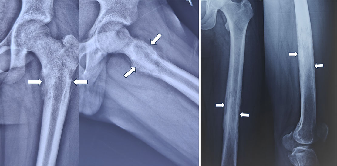 X-ray features of Ewing sarcoma X-ray features of Ewing sarcoma