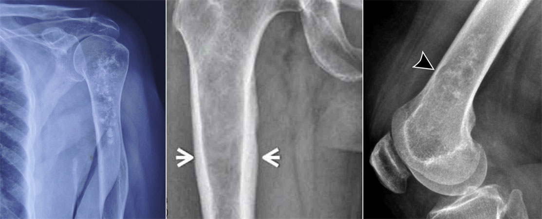 X-ray features of chondrosarcoma X-ray features of chondrosarcoma