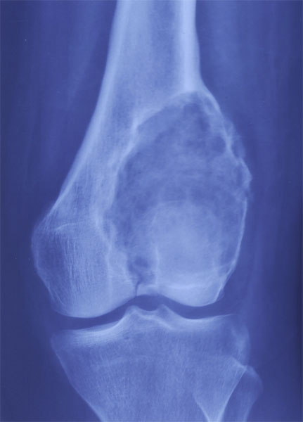X-ray showing a giant cell tumor of bone (GCT) involving the lower end of the femur near the knee joint