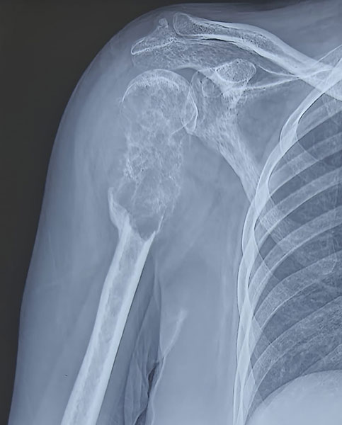 X-ray showing a metastatic bone lesion in the proximal humerus from breast cancer X-ray showing a metastatic bone lesion in the proximal humerus from breast cancer