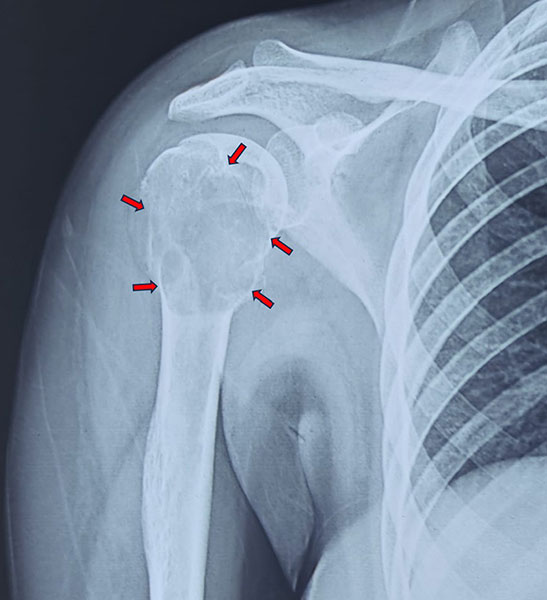 X-ray showing a tumor involving the proximal humerus near the shoulder joint X-ray showing a tumor involving the proximal humerus near the shoulder joint