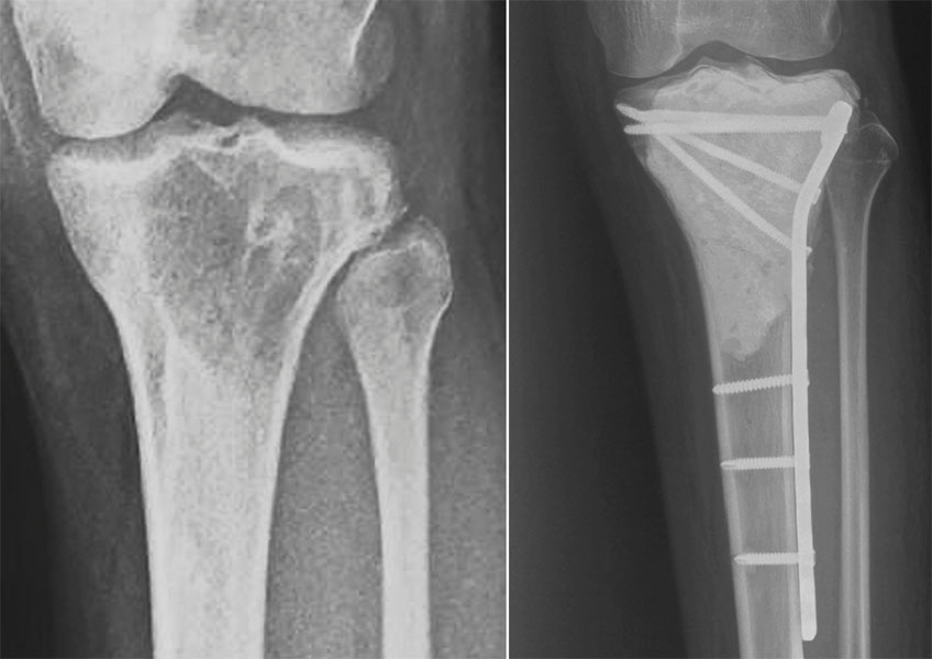 X-ray showing successful reconstruction after extended curettage and cementation of a giant cell tumor around the knee X-ray showing successful reconstruction after extended curettage and cementation of a giant cell tumor around the knee