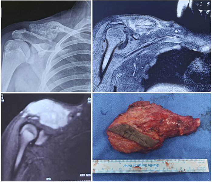 X-rays and MRI showing Ewing sarcoma of the clavicle, treated with wide surgical resection X-rays and MRI showing Ewing sarcoma of the clavicle, treated with wide surgical resection