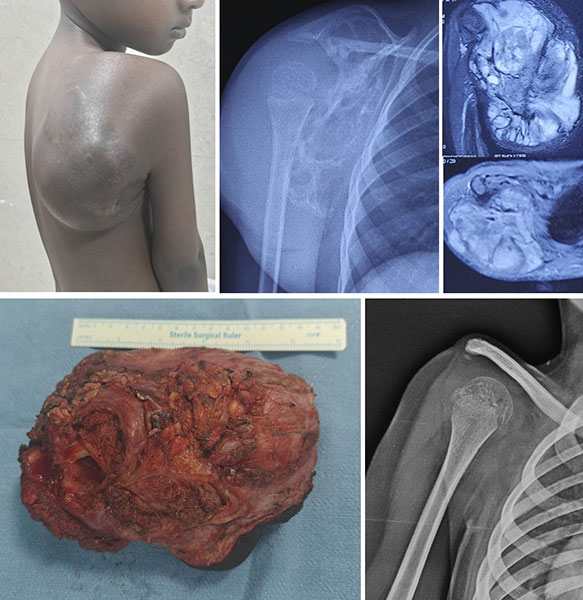 X-rays and MRI showing a scapular sarcoma. The tumor was treated with total scapulectomy as part of limb-salvage surgery X-rays and MRI showing a scapular sarcoma. The tumor was treated with total scapulectomy as part of limb-salvage surgery