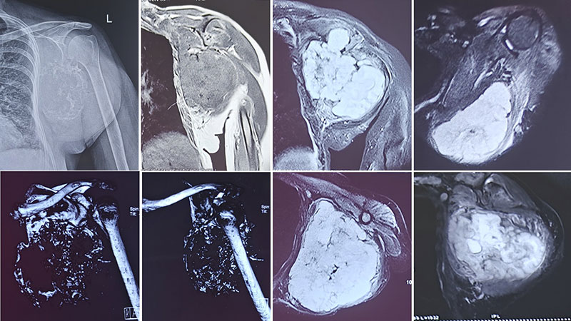 X-rays and MRI showing an extensive chondrosarcoma of the scapula X-rays and MRI showing an extensive chondrosarcoma of the scapula