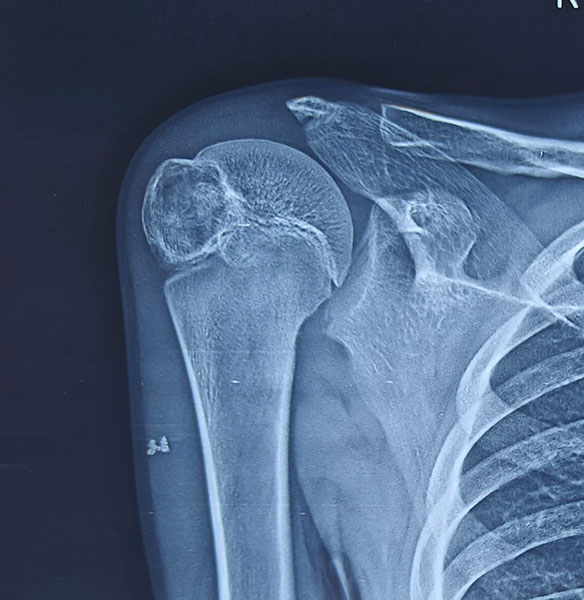 X-rays showing a chondroblastoma of the proximal humerus near the shoulder joint X-rays showing a chondroblastoma of the proximal humerus near the shoulder joint