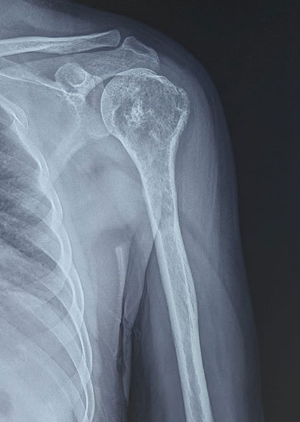 X-rays showing a chondrosarcoma of the proximal humerus, a malignant cartilage-forming bone tumor X-rays showing a chondrosarcoma of the proximal humerus, a malignant cartilage-forming bone tumor