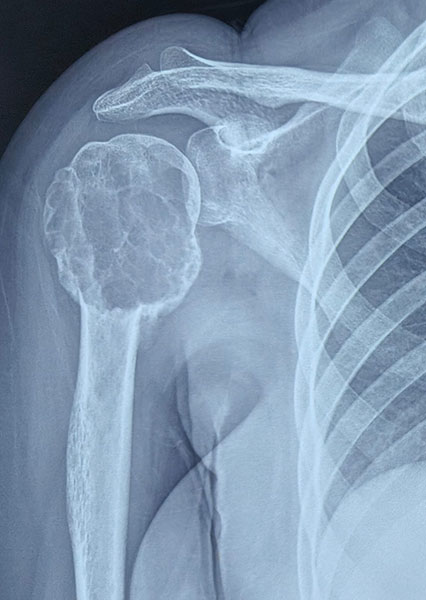 X-rays showing a giant cell tumor of the proximal humerus involving the shoulder region X-rays showing a giant cell tumor of the proximal humerus involving the shoulder region