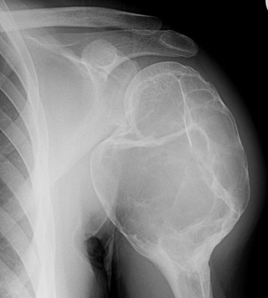 X-rays showing an aneurysmal bone cyst of the proximal humerus X-rays showing an aneurysmal bone cyst of the proximal humerus