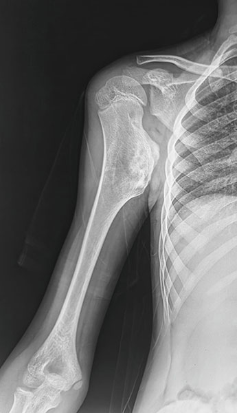 X-rays showing an osteochondroma of the proximal humerus, a common benign bone tumor near the shoulder X-rays showing an osteochondroma of the proximal humerus, a common benign bone tumor near the shoulder