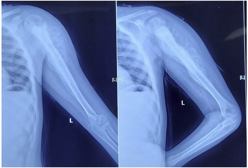 X-rays showing an osteosarcoma of the proximal humerus, a malignant bone tumor involving the shoulder region X-rays showing an osteosarcoma of the proximal humerus, a malignant bone tumor involving the shoulder region