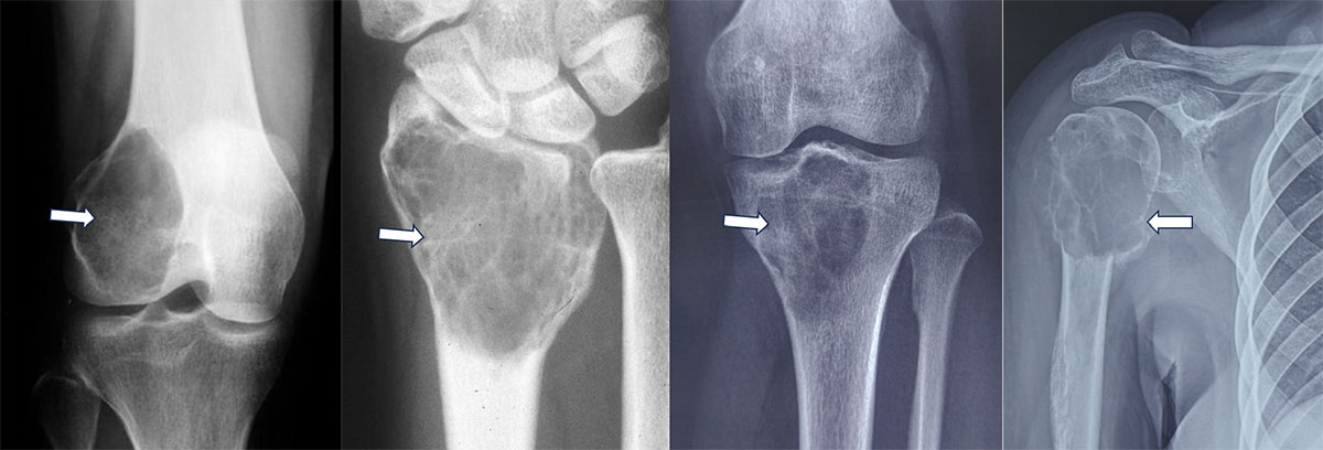 X-rays showing giant cell tumors of bone at different sites, with the characteristic expansile bone destruction highlighted X-rays showing giant cell tumors of bone at different sites, with the characteristic expansile bone destruction highlighted