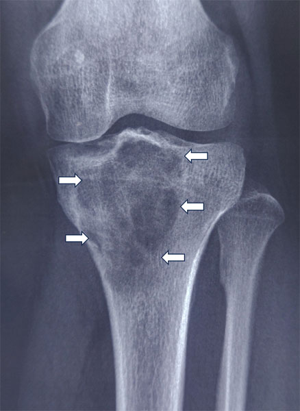 X-rays showing giant cell tumors of bone at different sites, with the characteristic expansile bone destruction highlighted X-rays showing giant cell tumors of bone at different sites, with the characteristic expansile bone destruction highlighted