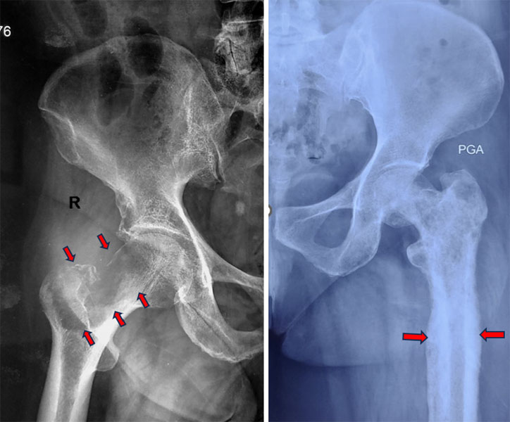 X-rays showing osteolytic (bone-destroying) and osteoblastic (bone-forming) bone metastases. These are two common patterns of metastatic bone disease seen on imaging