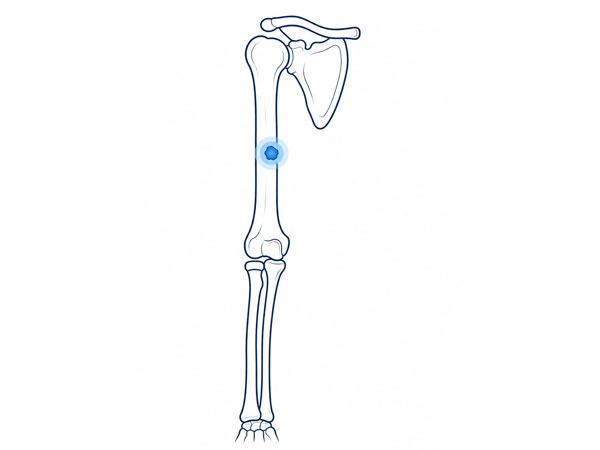Arm Bone Tumor
