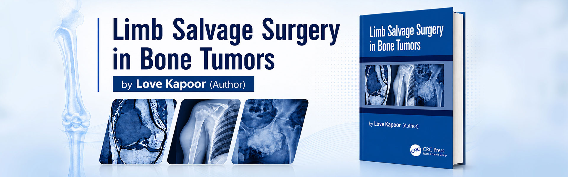 Limb salvage surgery in bone tumors