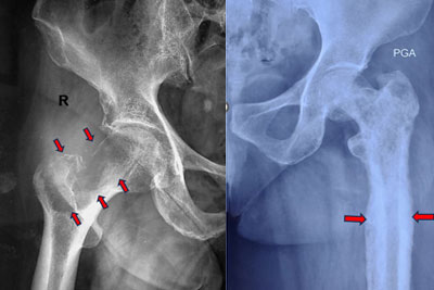Bone Metastasis Treatment