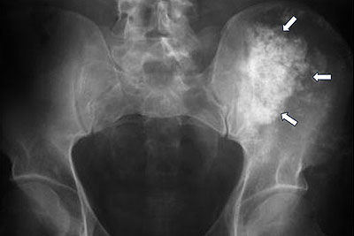 Chondrosarcoma