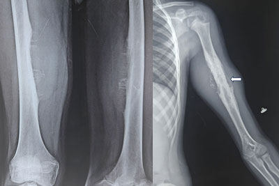 Ewing Sarcoma