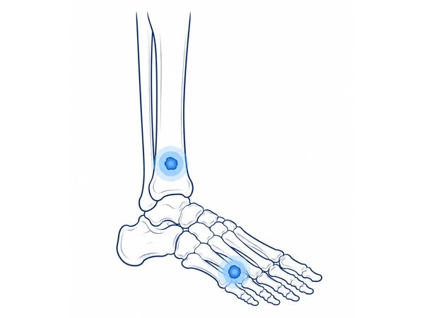 Foot and Ankle Bone Tumor