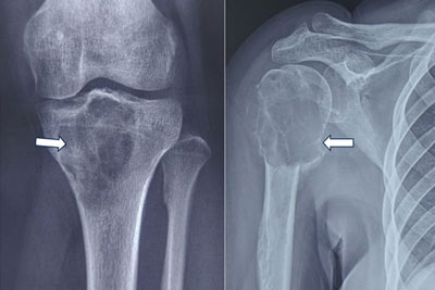 Giant Cell Tumor Of Bone (GCTB)